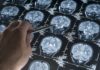Doença cerebral desconhecida coloca médicos em alerta